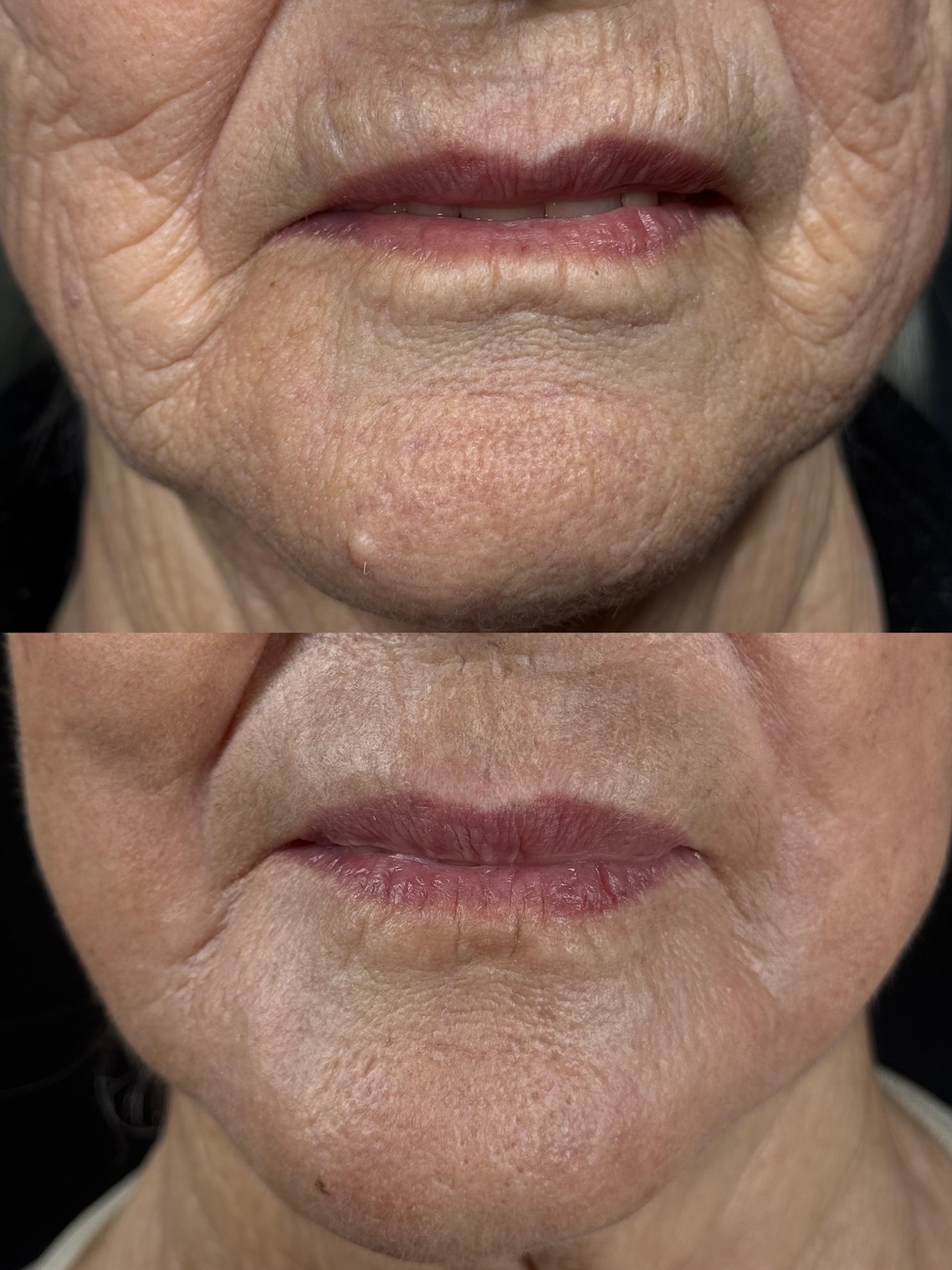 Antes e depois de caso Laser Hybrid conduzido por Gildete Zanella
