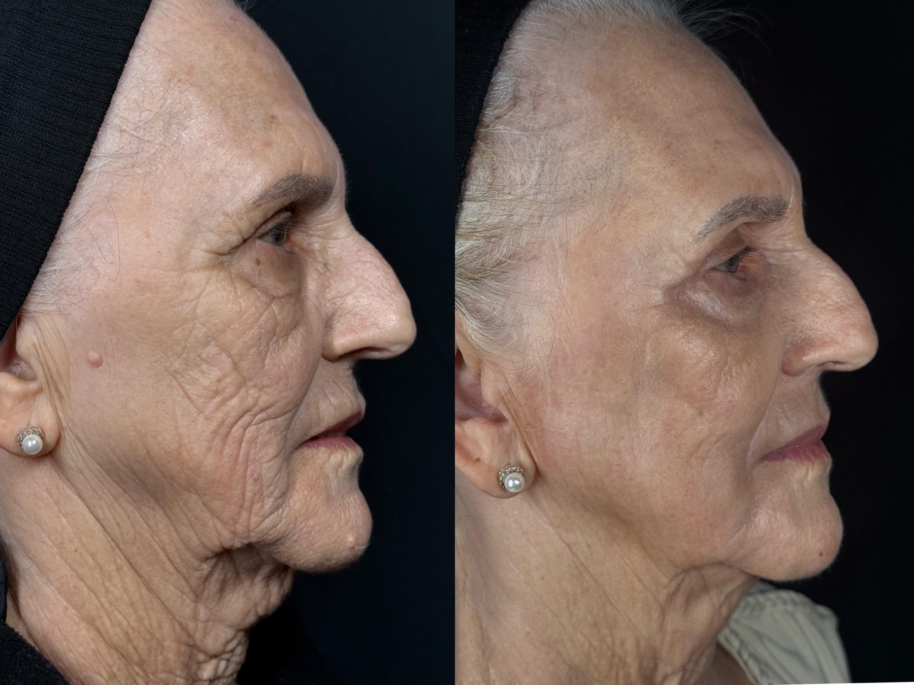 Antes e depois de caso Laser Hybrid conduzido por Gildete Zanella