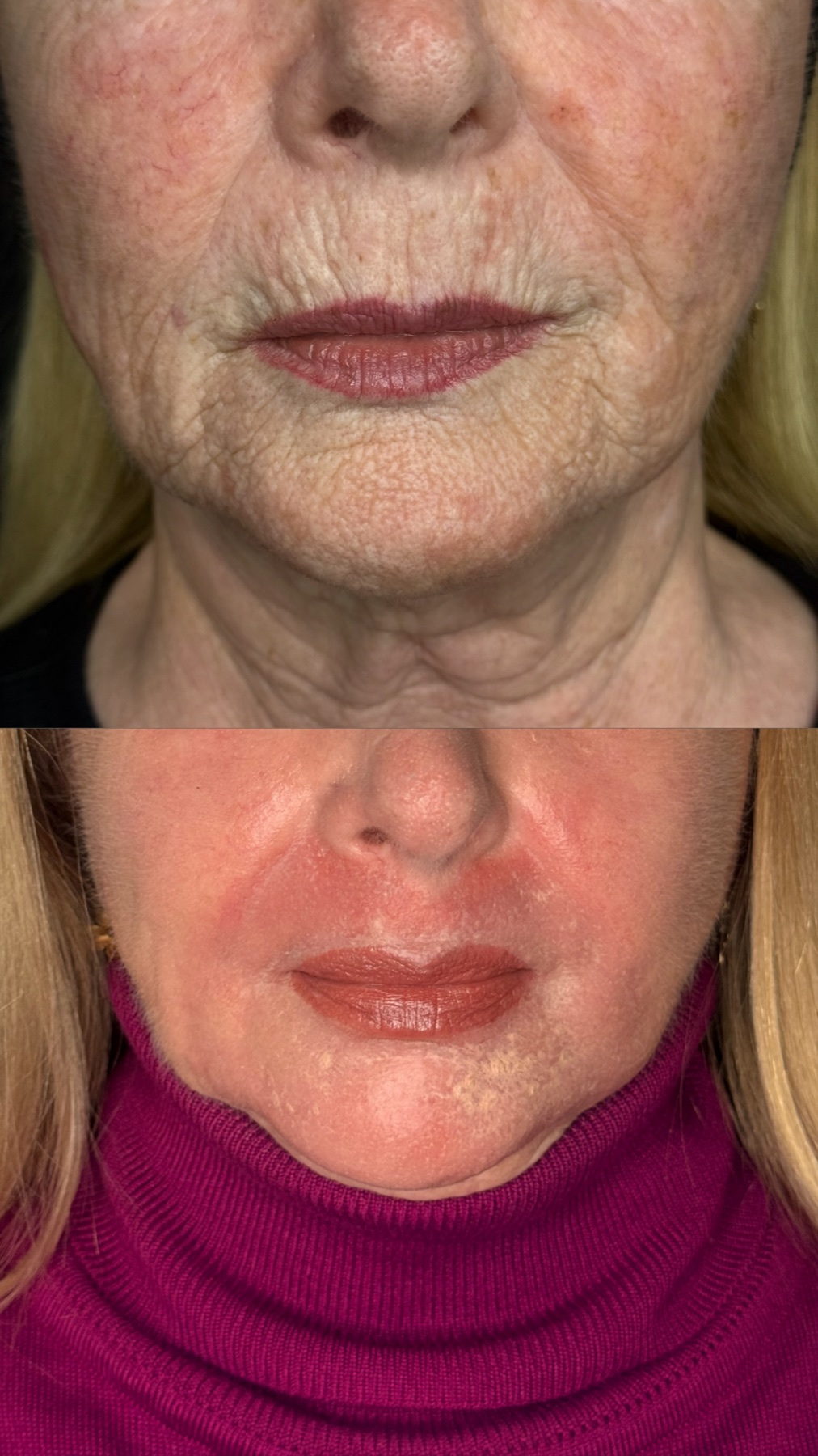 Antes e depois de caso Line Skin conduzido por Gildete Zanella