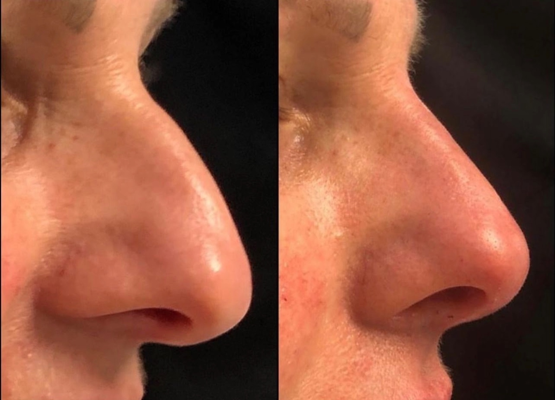 Antes e depois de caso de rinomodelação conduzido por Gildete Zanella